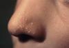 Жировики на лице: причины возникновения и лечение
